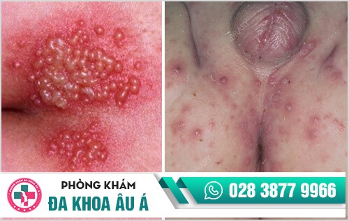 mụn rộp sinh dục