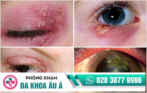 mụn rộp sinh dục