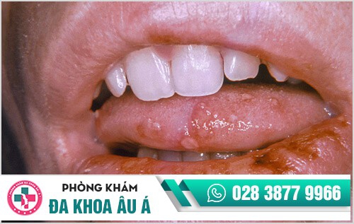 mụn rộp sinh dục