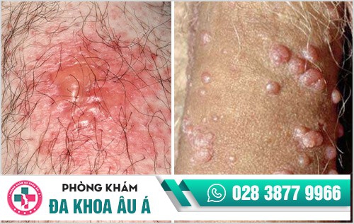 mụn rộp sinh dục