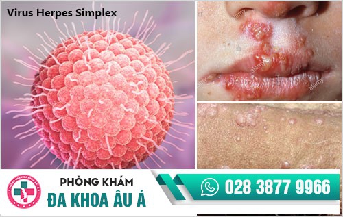 mụn rộp sinh dục nam 