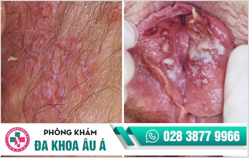 mụn rộp sinh dục