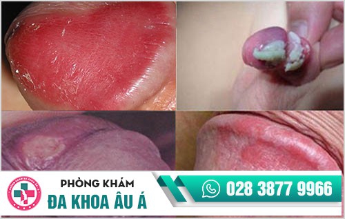mụn sinh dục