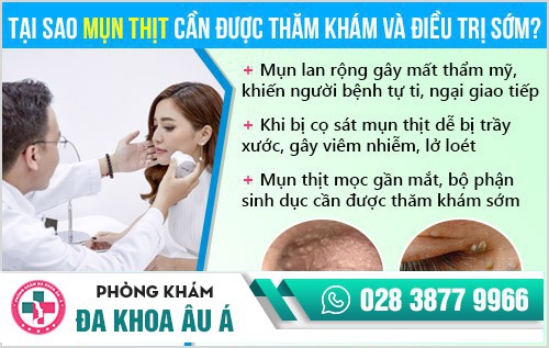 Mụn thịt và giải pháp hỗ trợ điều trị hiệu quả