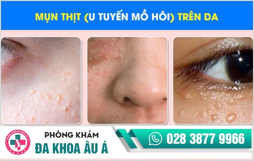 Mụn thịt và giải pháp hỗ trợ điều trị hiệu quả