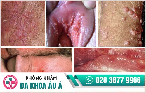 thuốc chữa trị mụn vùng kín