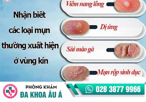 Nổi mụn ở môi lớn và môi bé âm đạo cảnh báo nguy hiểm 