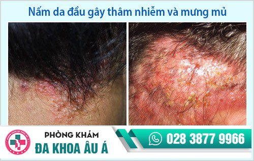 điều trị nấm da đầu