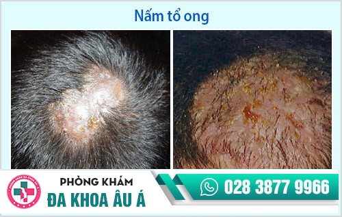 điều trị nấm da đầu