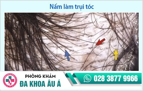điều trị nấm da đầu