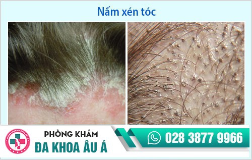 điều trị nấm da đầu