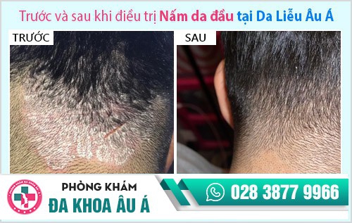 điều trị nấm da đầu