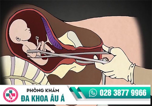 Hình ảnh nạo thai an toàn