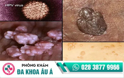 điều trị sùi mào gà ở đâu,trị sùi mào gà ở đâu uy tín, nên điều trị sùi mào gà ở đâu