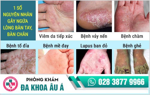 ngứa lòng bàn tay bàn chân