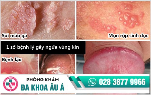 ngứa rát bộ phận sinh dục