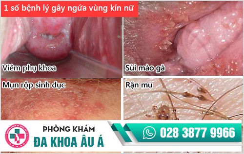 ngứa rát bộ phận sinh dục