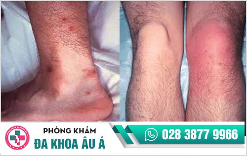 nguyên nhân bệnh lậu ở nam giới