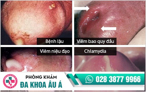 4 nguyên nhân khiến cậu nhỏ chảy mủ bạn cần biết