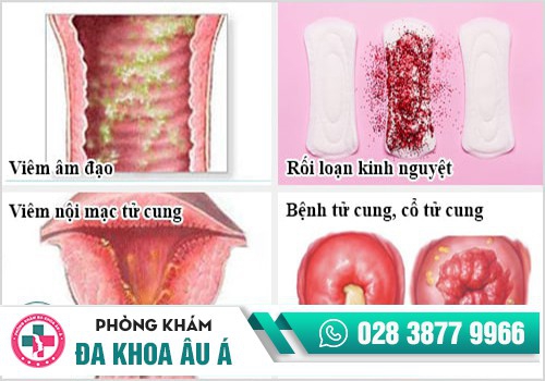 Chảy máu âm đạo - nguyên nhân và cách hỗ trợ điều trị