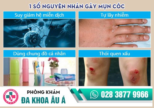 Mụn cóc là gì? 