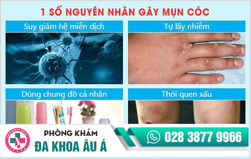 Nguyên nhân gây mụn cóc