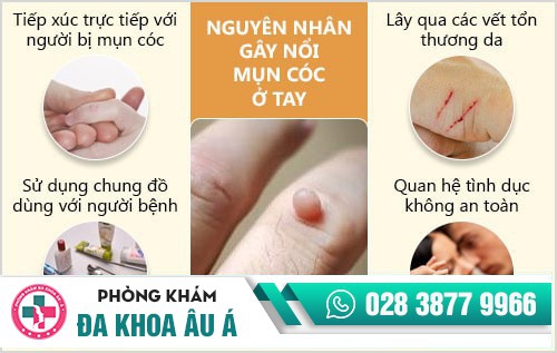 mụn cóc ở tay