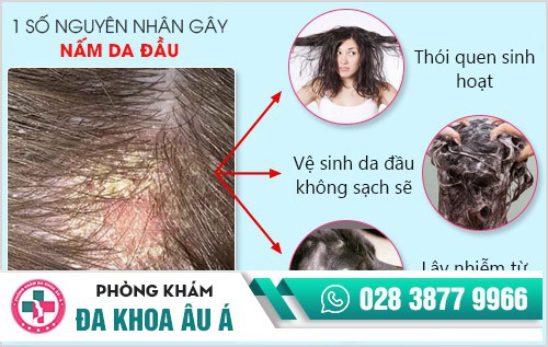 Cách chữa nấm da đầu hiệu quả chỉ trong 1 liệu trình