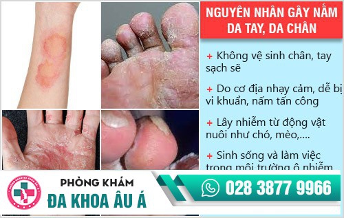 Bệnh nấm da tay, chân là gì?