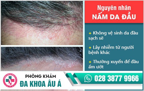 Nấm da đầu cách trị tốt nhất và dứt điểm