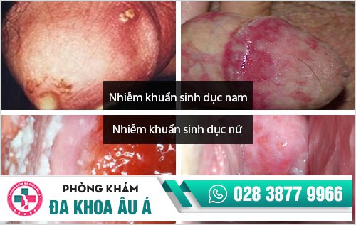 Dấu hiệu nhận biết nhiễm khuẩn sinh dục và cách điều trị hiệu quả Dấu hiệu nhận biết nhiễm khuẩn sinh dục và cách điều trị hiệu quả