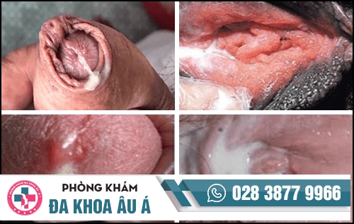 Niệu đạo chảy mủ có phải bệnh lậu không?