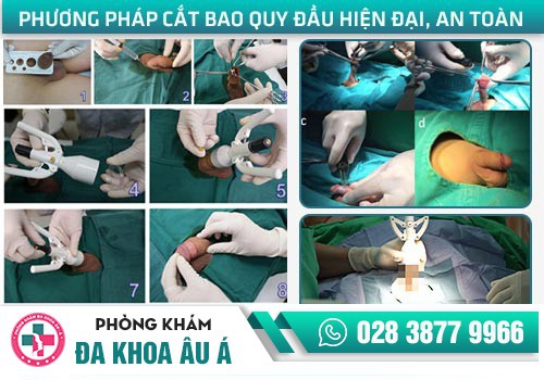 Cắt bao quy đầu an toàn, hiệu quả