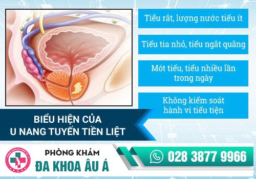 Cẩn thận với chứng u nang tuyến tiền liệt