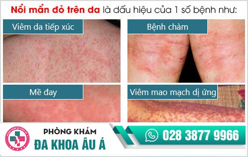 Nổi mẩn đỏ trên da