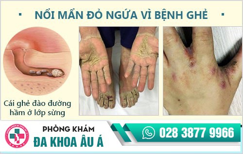 Da nổi mẩn đỏ ngứa