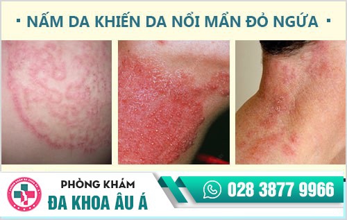 Da nổi mẩn đỏ ngứa