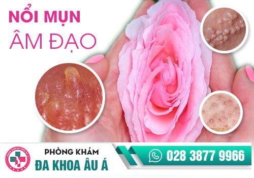 NỔI MỤN ÂM ĐẠO LÀ BỆNH GÌ?