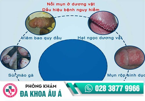 Nổi mụn thịt ở bìu tinh hoàn là dấu hiệu bệnh gì? 