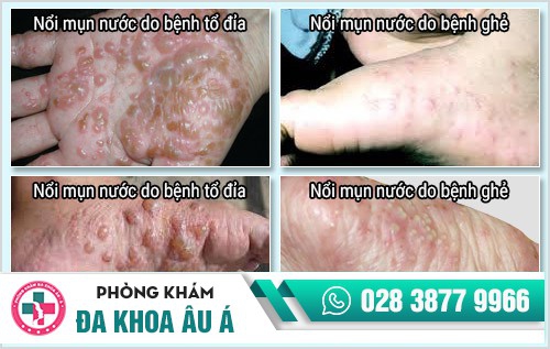 nổi mụn nước