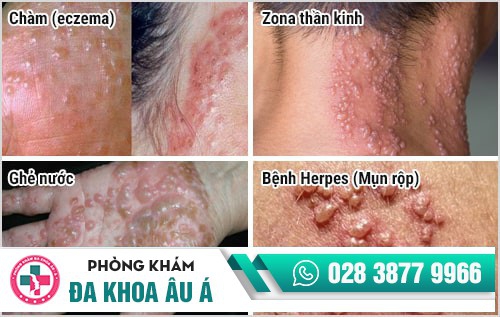 chữa nổi mụn nước