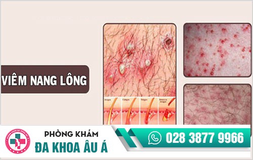 nổi mụn ở môi lớn, mọc mụn ở môi bé