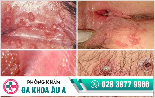 nổi mụn ở môi lớn, mọc mụn ở môi bé