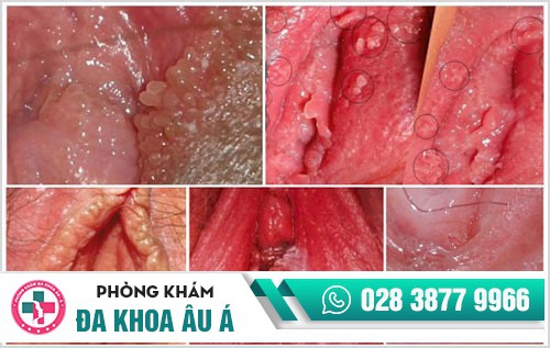 nổi mụn ở môi lớn, mọc mụn ở môi bé