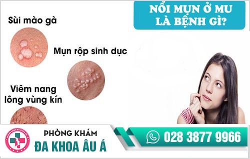 nổi mụn ở mu vùng kín