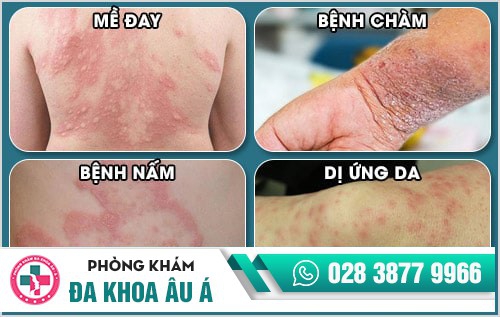 nổi nốt đỏ và ngứa trên da
