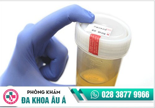 NGUYÊN NHÂN KHIẾN NƯỚC TIỂU CÓ MÙI HÔI LÀ GÌ? 