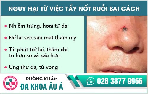 tẩy nốt ruồi
