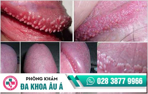 Phương pháp điều trị hạt ngọc dương vật