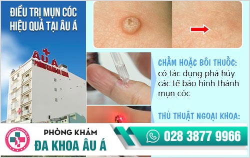 mụn cóc ở tay